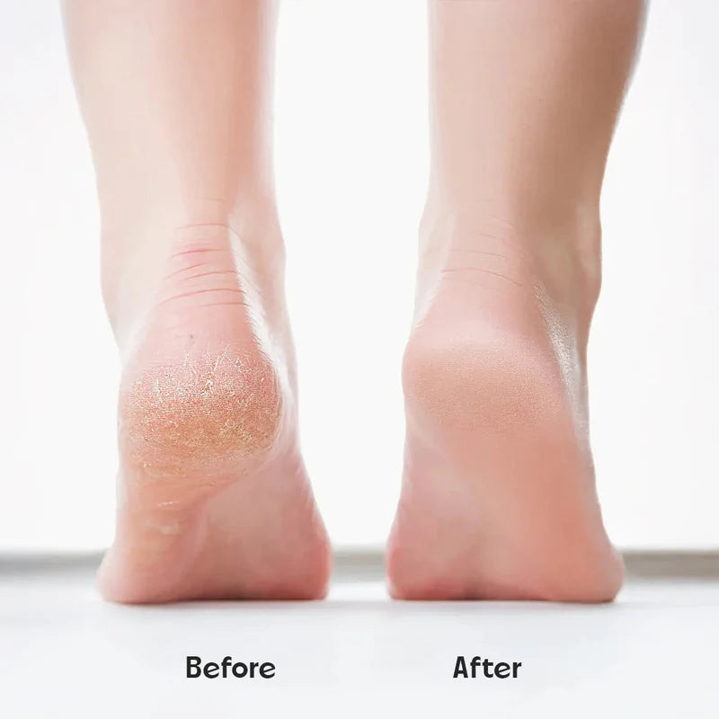 SilkSole™ Electronic Pedicure