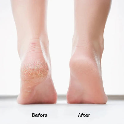 SilkSole™ Electronic Pedicure