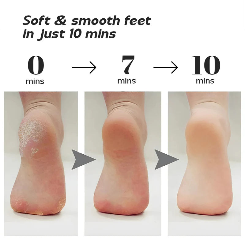 SilkSole™ Electronic Pedicure